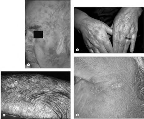 Actinic Keratoses Pre-cancerous 1 AK will become SCC 10% of the