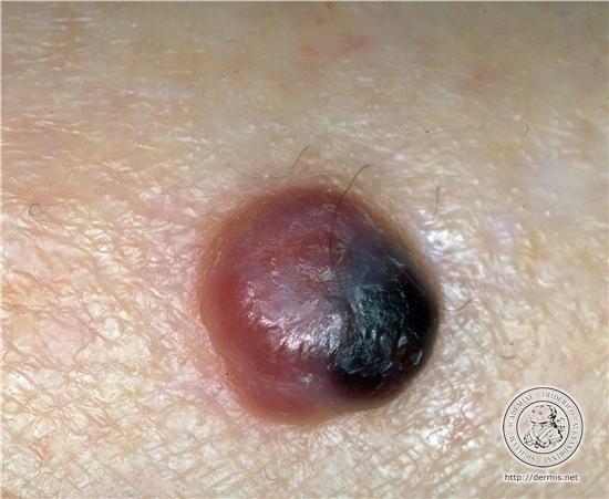 melanoma Skin lesion with