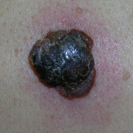 Final Tips Nodular melanomas can be rapidly