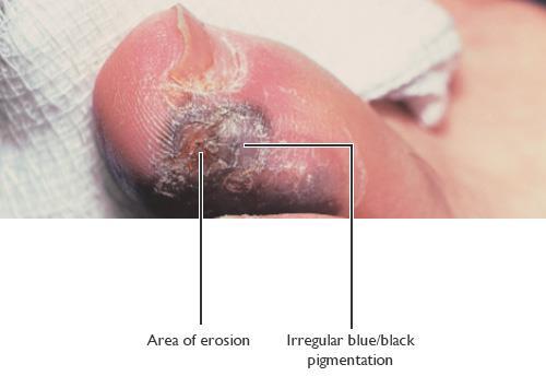 Final Tips Be wary pigmented lesion on finger or sole of foot: Acral lentiginous
