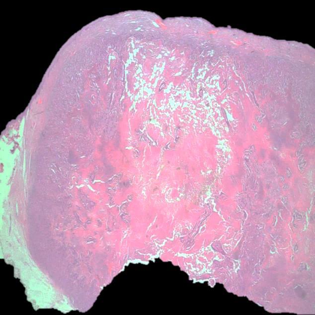 in colorectal carcinoma Lack of connection to the epidermis
