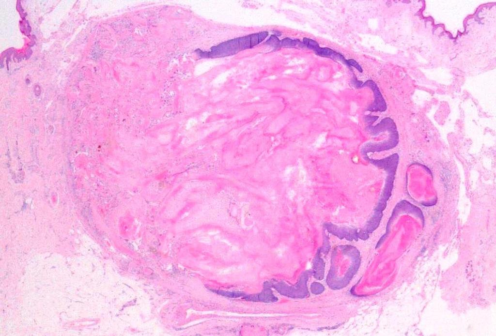 Case 18: Differential diagnosis: pilomatrical carcinoma Areas