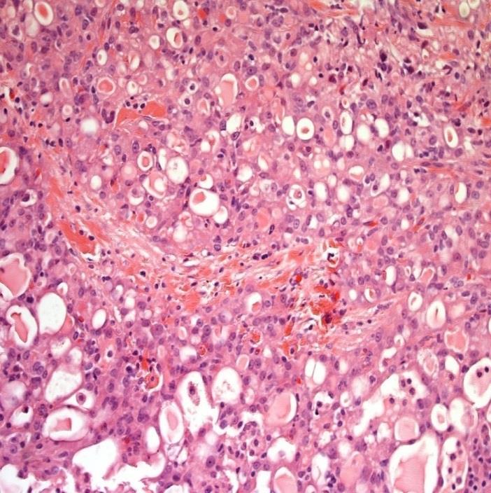 Growth pattern and glandular/ductal morphology not typical for primary carcinoma?
