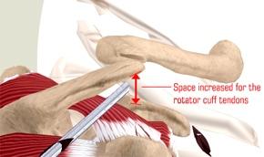 The cuff tear is repaired using suture anchors that are small metal anchors that go into bones and stay there permanently.