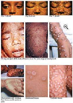 Smallpox (Variola virus) Smallpox is communicable Droplet and airborne precautions Infectious until scabs