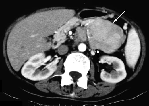 1 58-year-old woman with treated primary extramedullary plasmacytoma of mediastinum who relapsed with multiple solitary plasmacytoma 9 months later.