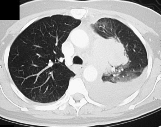 Fig. 3 53-year-old woman with multiple solitary plasmacytoma., Contrast-enhanced axial CT scan of thorax shows mass arising from left upper lobe with left pleural effusion.