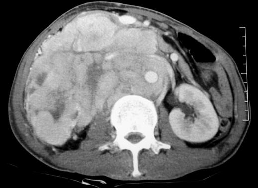 Radiologic Manifestations of Plasmacytomas C Fig. 4 49-year-old man with multiple solitary plasmacytomas arising from right kidney and mediastinum.