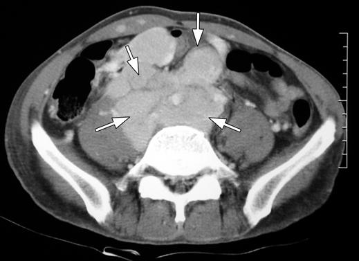 retroperitoneal and mesenteric lymph nodes are visible. Six months after radiation therapy and chemotherapy, recurrent solitary plasmacytomas were found in mediastinum and right adrenal.