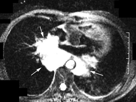 D, xial postcontrast CT scan shows another extramedullary plasmacytoma (asterisks) with central necrosis and heterogeneous enhancement arising from right adrenal gland.