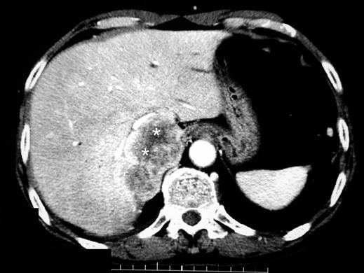 in 7% of the patients [9]. Treatment of primary plasmacytoma is aimed at local control with local radiation therapy, surgical resection, or both depending on the site.