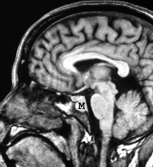 cranial fossa., On T1-weighted sagittal scan of brain, a second lesion (M) is revealed to arise behind dorsum sella and clivus. It appears isointense to white matter.