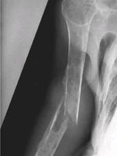 Clinical Consequences of Myeloma Bone Disease Pathological fractures Non-vertebral Vertebral compression Spinal cord compression/collapse Radiation therapy