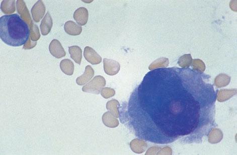 MULTIPLE MYELOMA 343 Fig. 7.20 BM trephine biopsy section, multiple myeloma, showing a fibroblastic reaction to myelomatous infiltration.