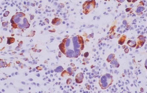 21), showing giant myeloma cells which were confused with