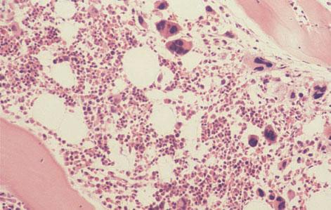 However, the giant cells were negative for CD61, positive for a plasma