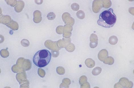 346 CHAPTER SEVEN Fig. 7.23 PB film in plasma cell leukaemia, showing marked rouleaux formation and two dysplastic plasma cells, one with an intranuclear inclusion (Dutcher body). MGG 940.