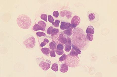 348 CHAPTER SEVEN Fig. 7.24 BM aspirate, Waldenström s macroglobulinaemia, showing a mast cell and mature small lymphocytes. MGG 940. Fig. 7.25 BM aspirate, Waldenström s macroglobulinaemia (same case as in Fig.