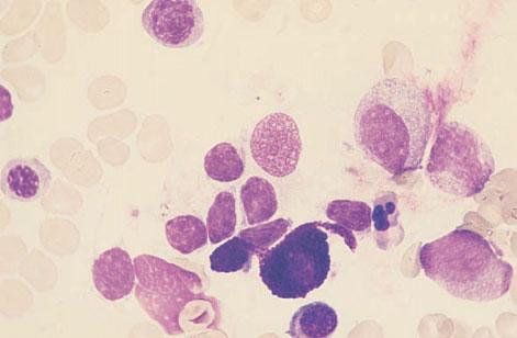 The incidence of Waldenström s macroglobulinaemia is about a tenth that of multiple myeloma.