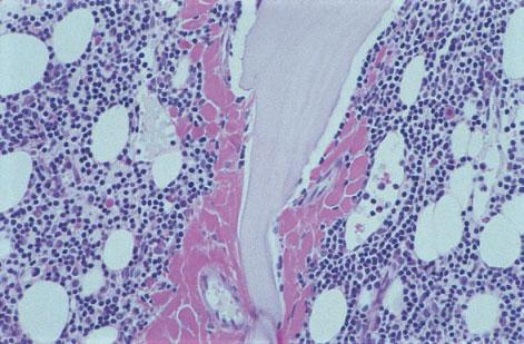 intrasinusoidal paraprotein, PAS stain 94. Table 7.1 Monoclonal gammopathies (modified from [49]).