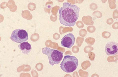 MULTIPLE MYELOMA 333 Fig. 7.1 BM aspirate, multiple myeloma, showing a range of cells from a plasmablast to mature plasma cells. MGG 940. years.