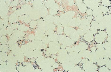 354 CHAPTER SEVEN Fig. 7.30 BM trephine biopsy section, showing amyloid in the walls of small blood vessels. Paraffin-embedded, Giemsa stain 376. Fig. 7.31 BM trephine biopsy section, light chain-associated amyloidosis (AL type), showing deposition of amorphous eosinophilic material in the interstitium.
