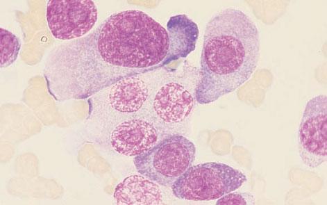 myeloma cells and myeloma cells with flaming cytoplasm. MGG 940.
