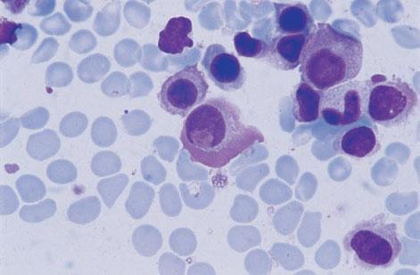 336 CHAPTER SEVEN Fig. 7.8 BM aspirate, multiple myeloma, showing numerous Russell bodies. MGG 940. Fig. 7.9 BM aspirate, multiple myeloma, showing formation of a Dutcher body by invagination from the cytoplasm.
