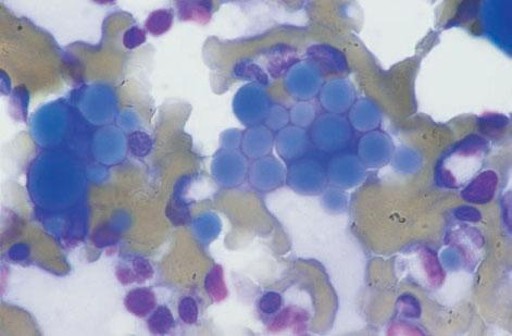 It is not always possible to make a diagnosis of multiple myeloma on the basis of bone marrow morphology alone.