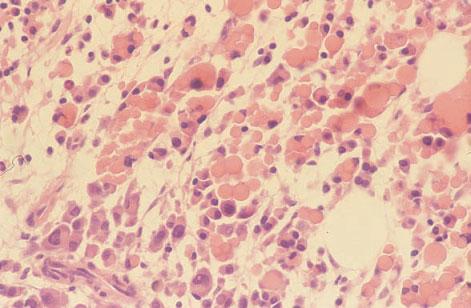 MULTIPLE MYELOMA 339 Fig. 7.14 BM trephine biopsy section, multiple myeloma (plasmablastic), showing plasmablasts with marked variation in nuclear size and shape and prominent central nucleoli.