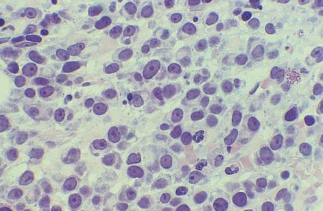 reticulin deposition, lymphoid infiltrates and, occasionally, the presence of granulomas (see Fig. 3.29). Bone marrow vascularity is increased and is indicative of a worse prognosis [13,14].