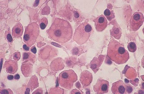 340 CHAPTER SEVEN Fig. 7.16 BM trephine biopsy section, multiple myeloma, showing a striking deposition of crystals of immunoglobulin. Paraffin-embedded, H&E 940. (By courtesy of Dr P Hayes, Chatham.