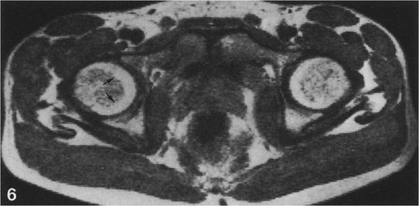 P.J. Linrup et al. : Magnetic resonance imaging of femoral head 161 Fig. 5. Magnified axial MRI (TR = 1.