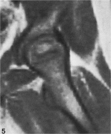 Axial MRI (TR = 0.5) of a 27-year-old man showing a bright medial crescent within the femoral head, corresponding to the fused epiphysis at this section level (arrows).