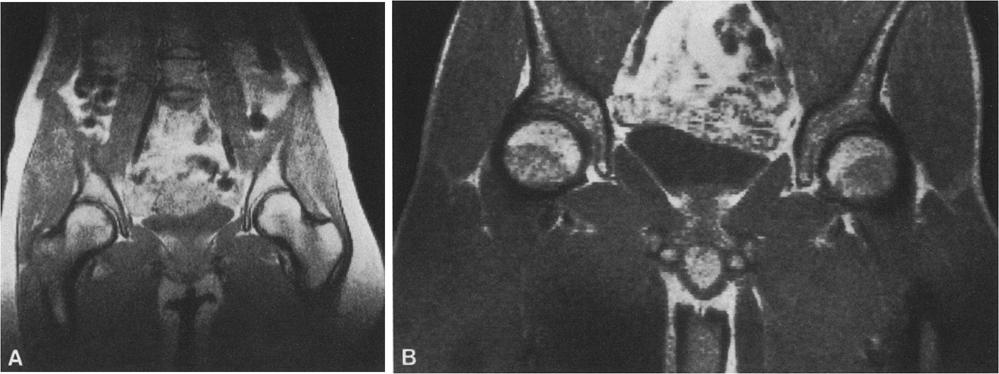 0) of a 15-year-old girl displaying bright femoral capital and greater trochanteric epiphyses which appeared fused on plain films. B Coronal MRI (TR= 1.