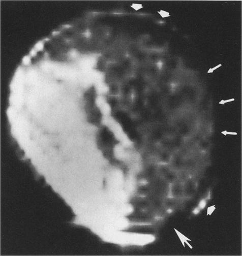 162 P.J. Littrup et al.: Magnetic resonance imaging of femoral head Fig. 8.