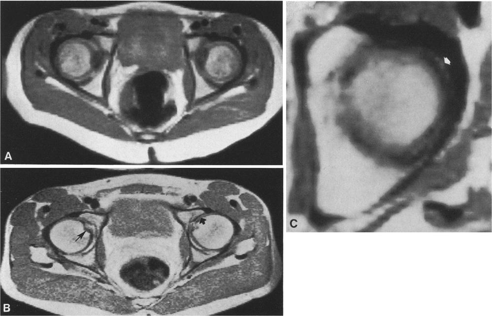 of cartilage scraped off with a knife (large arrow). (TR=0.5 s; TE=28 ms) Fig. 9. A Axial MRI (TR = 2.0) of a 6-year-old girl showing prominent bright "halos" about the femoral heads.