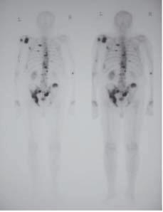 4. NUCLEAR MEDICINE INVESTIGATIONS 155 FIGURE 4.4. Bone scan showing widespread metastatic hotspots Typically, multiple sclerotic deposits are located in the pelvis and lumbar spine, although any