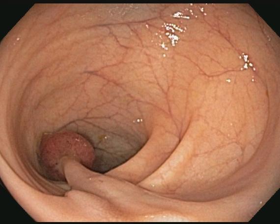 Longer withdrawal time is associated with a reduced incidence of interval cancer after screening colonoscopy.