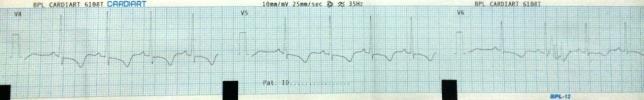 9 Figure 3: ECG after 48 hours of acute stroke (1) QTc interval=0.44sec, (2) T-wave inversion in lead I, avl, V2-V6).
