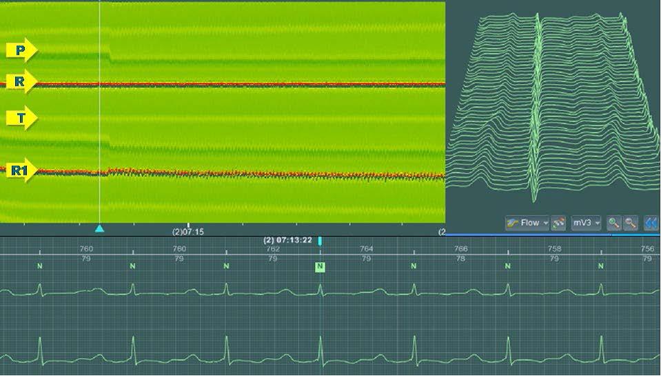 Alternate of PQ interval: On the left: AV conduction disorder,