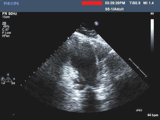 67 y/o woman developed chest pain attending KY Derby Cath