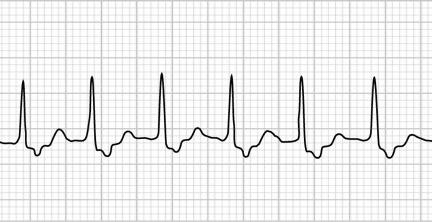 AV nodal re-entry tachycardia Orthodromic Case 4 - ECG