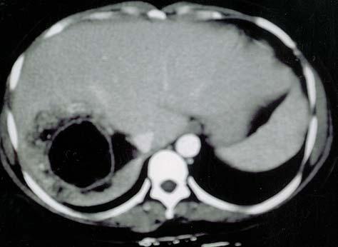 697 Cheng-Han Chao, et al A B Figs. 1 (A) Enhanced CT scan of abdomen revealed a lobulated mass in the right lobe of the liver, containing fat and soft tissue components.