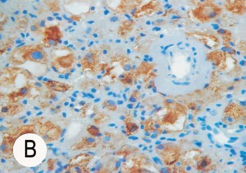 some tumor cells (paraffin immunohistochemical stain, 100 ); (C) The left part of the photograph depicts fragmented tissue as degenerate features admixed with chronic inflammatory cell infiltrate.