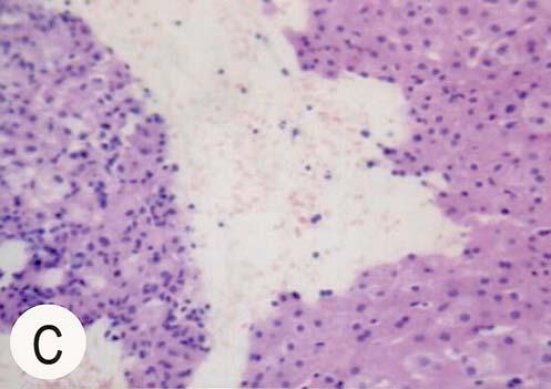 fragmented degenerative-like tissue (left portion) while the liver parenchyma remains not stainable (right portion) (paraffin immunohistochemical stain, 100 ) cal intervention was performed and the