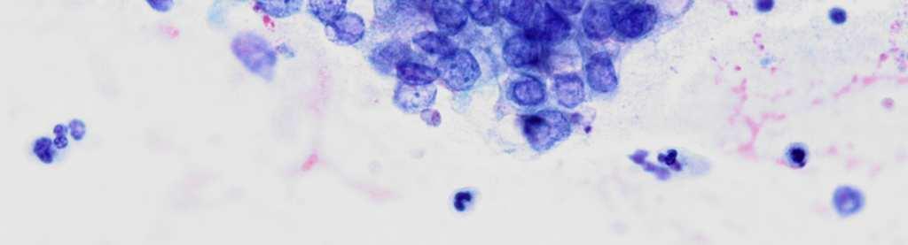 Prostate Endometrioid Bile duct Stomach FNA of