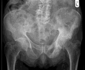 old male referred with pain in left hip/thigh Reduced mobility