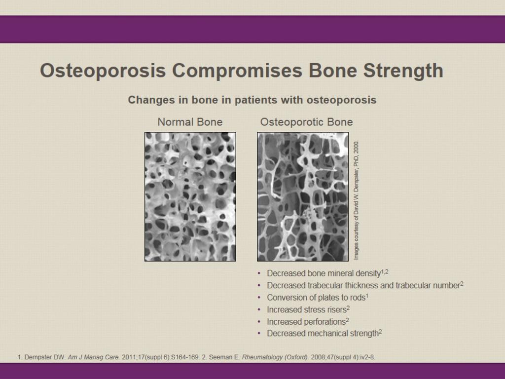 1986:1:15-21 Reprinted with permission from the American Society of Bone and Mineral Research Evaluating Bone Strength Bone strength primarily reflects the integration of BMD and bone quality 1 Bone