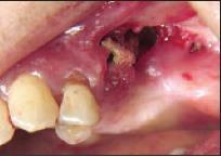 Smoking Pre-existing dental disease, anemia, coagulopathy, and infection Management Povidone-iodine & 0.